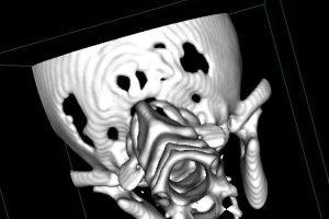 Chiari-Malformatie en Syringomyelie